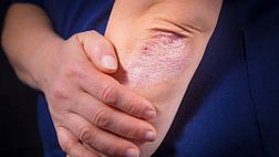 Psoriasis on the elbow
