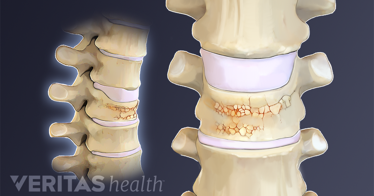 compression bone fracture