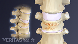 Profile and anterior view of a vertebral compression fracture