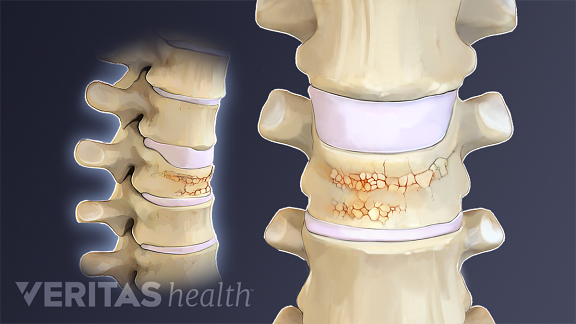  Illustrazione medica di una frattura vertebrale da compressione