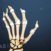 Dorsal view of the hand showing joint deformity in the knuckles caused by rheumatoid arthritis.