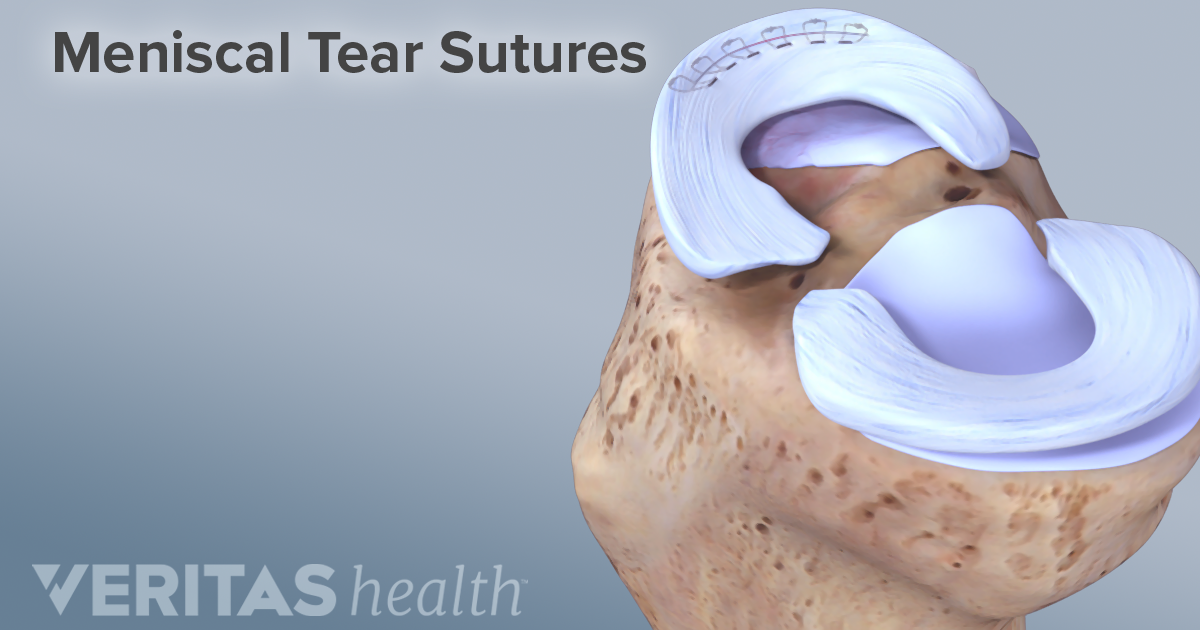 Meniscal Tear Treatment