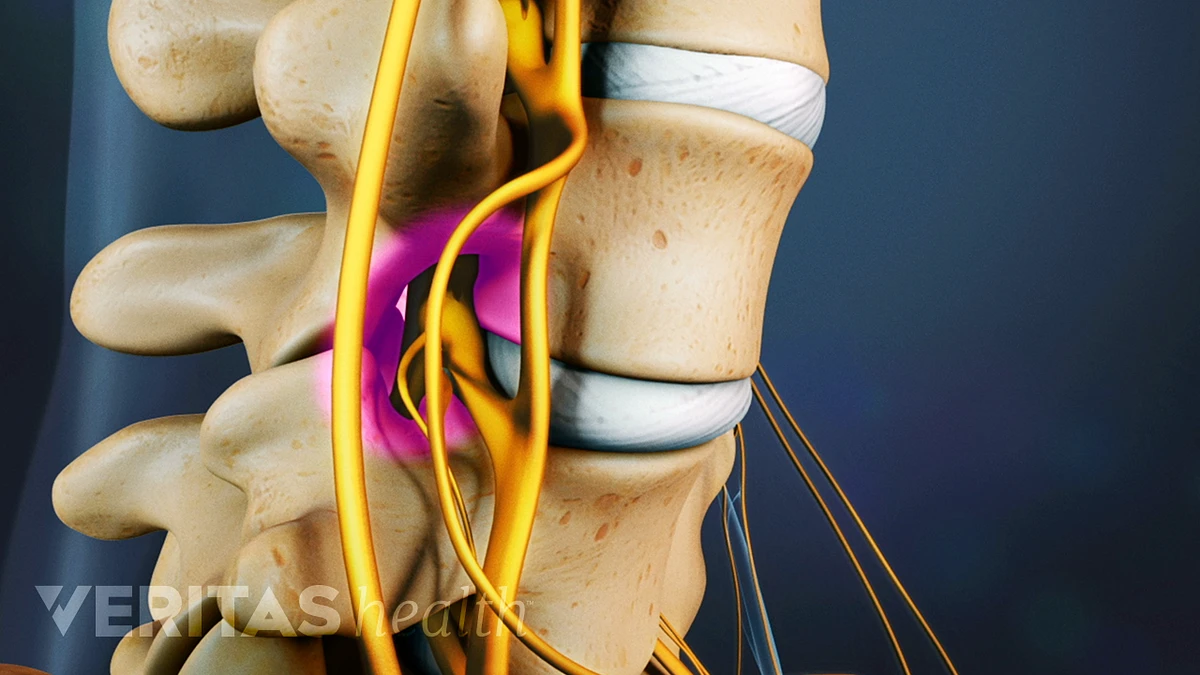 Could you have spinal stenosis?