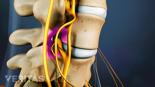 synovial cyst spine forum synovial cyst spine forum