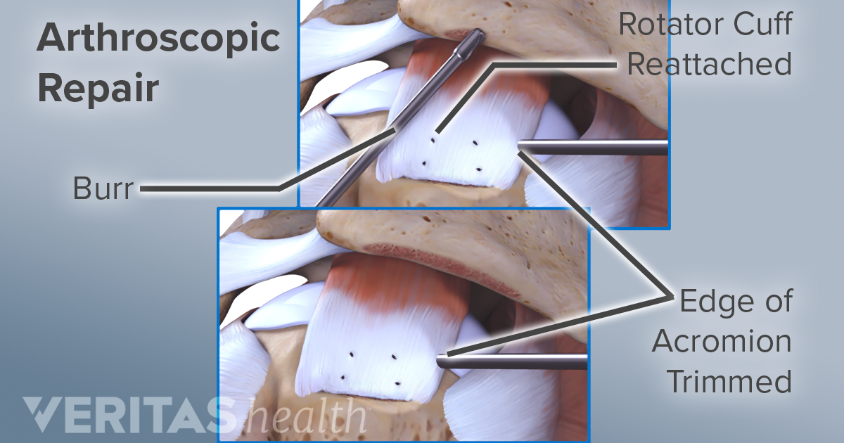 Rotator Cuff Repair Surgery