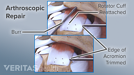 Arthroscopic rotator cuff surgery
