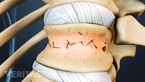 vertebral fracture