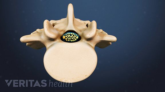 Lumbar Spinal Stenosis