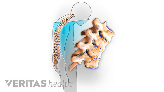 Inset of the spine showing a hunch posture in the upper back.