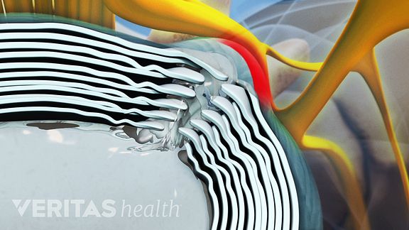 Herniated Disc Video
