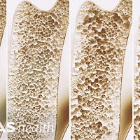 Four bones side by side with varying bone density.