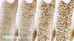 Ostroporosis