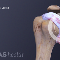 Anterior view of the shoulder joint with scarring and adhesions.