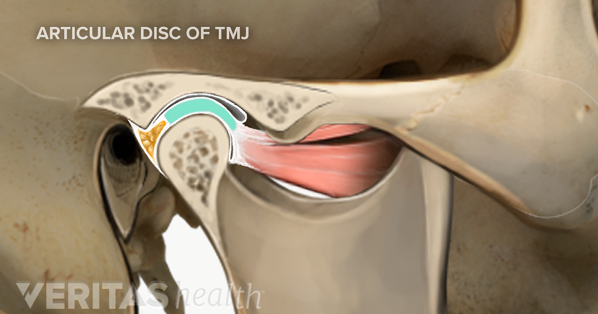 Pain Sources In Temporomandibular Joint (TMJ) Disorders