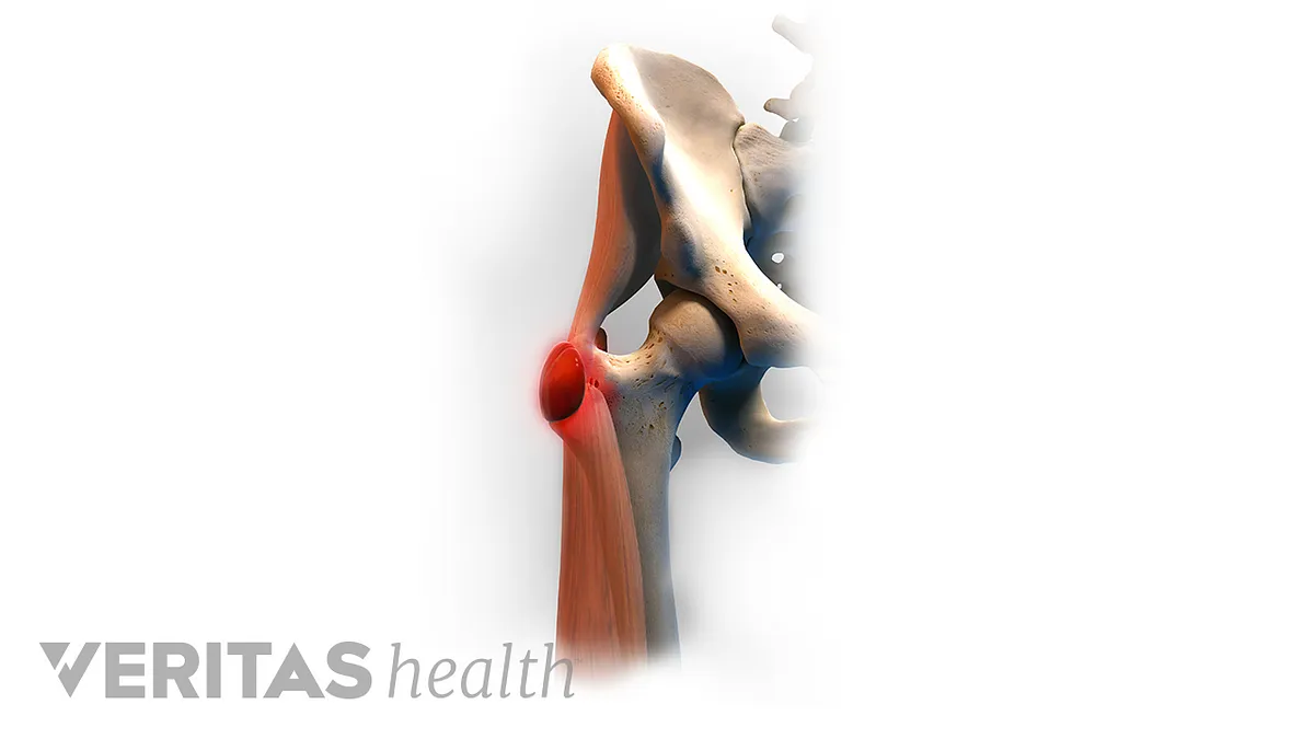 Hip Bursitis Pain Relief - Professional Physical Therapy