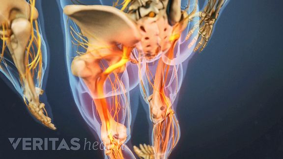 When a bone spur impinges on a nerve in the lumbar spine, it can cause radiating pain, weakness, tingling, and numbness in the legs and feet.