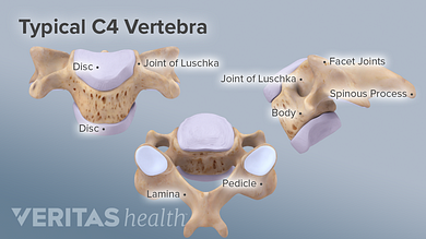 Artroza vertebrală spondilartroză