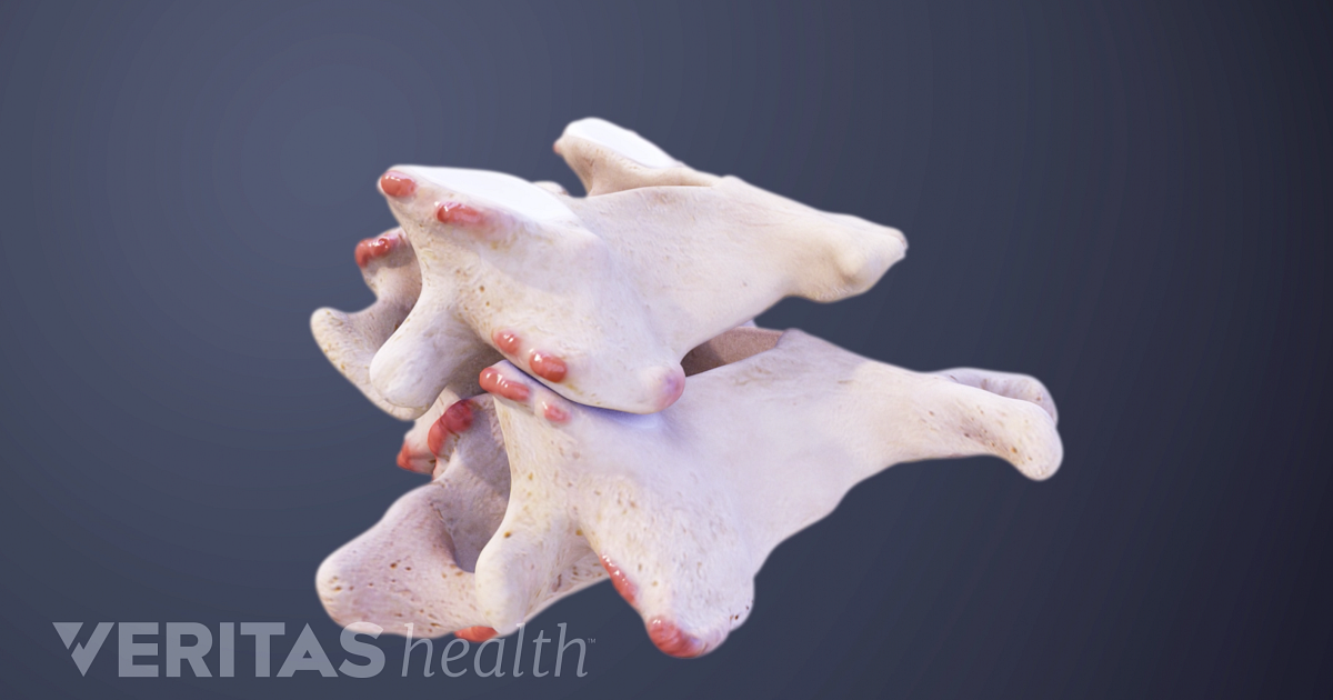 Cervical Bone Spurs Symptoms And Causes Animation 9519