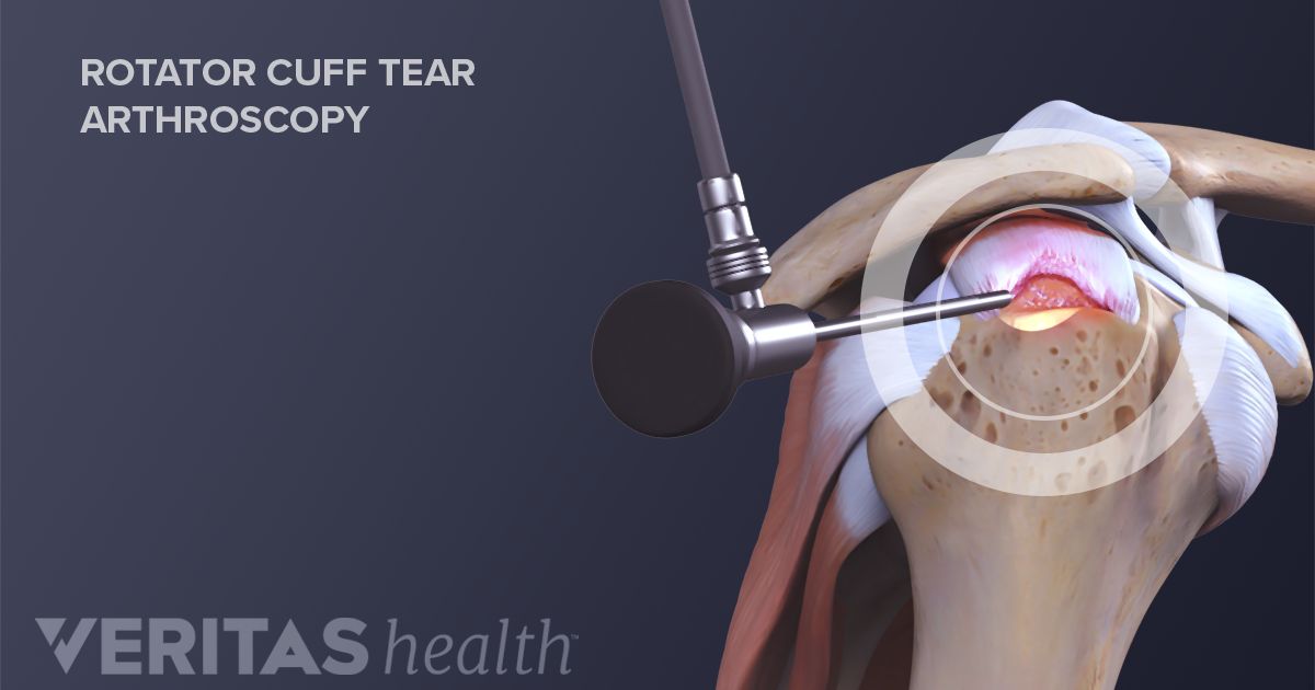 therapy after rotator cuff surgery