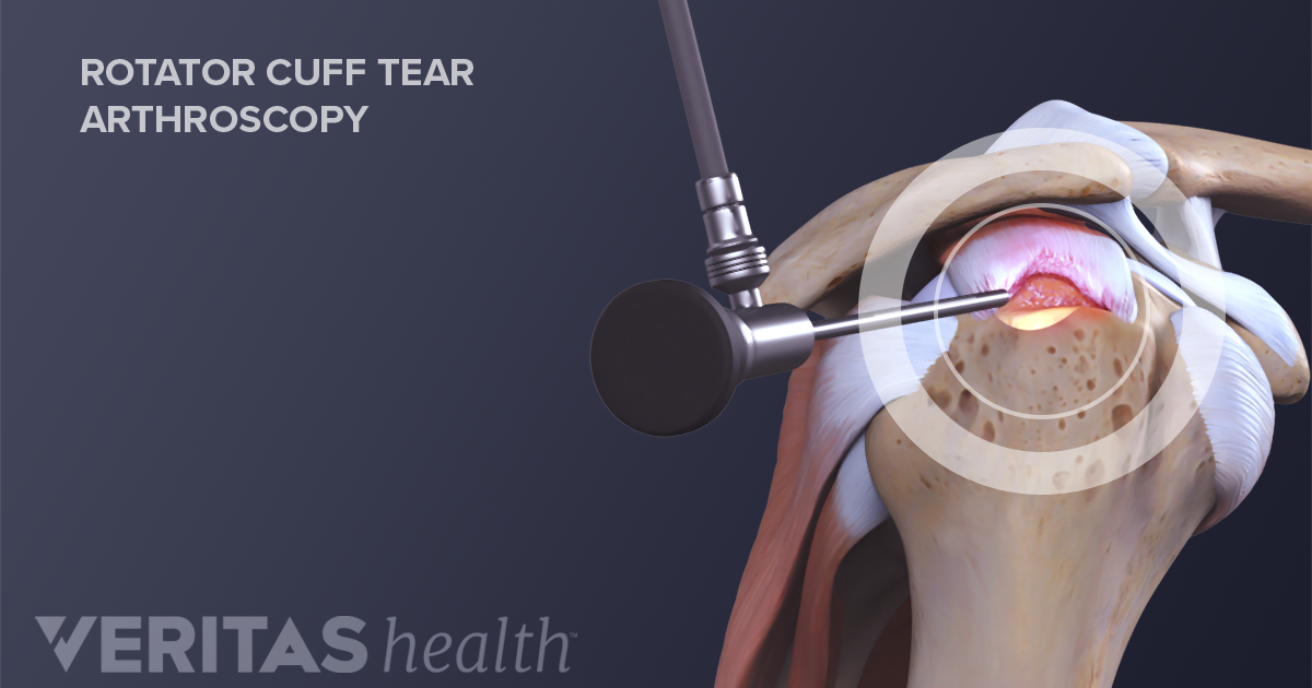 Rotator Cuff Tear Surgery