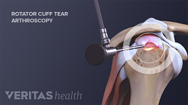 Arthroscopic rotator cuff tear surgery