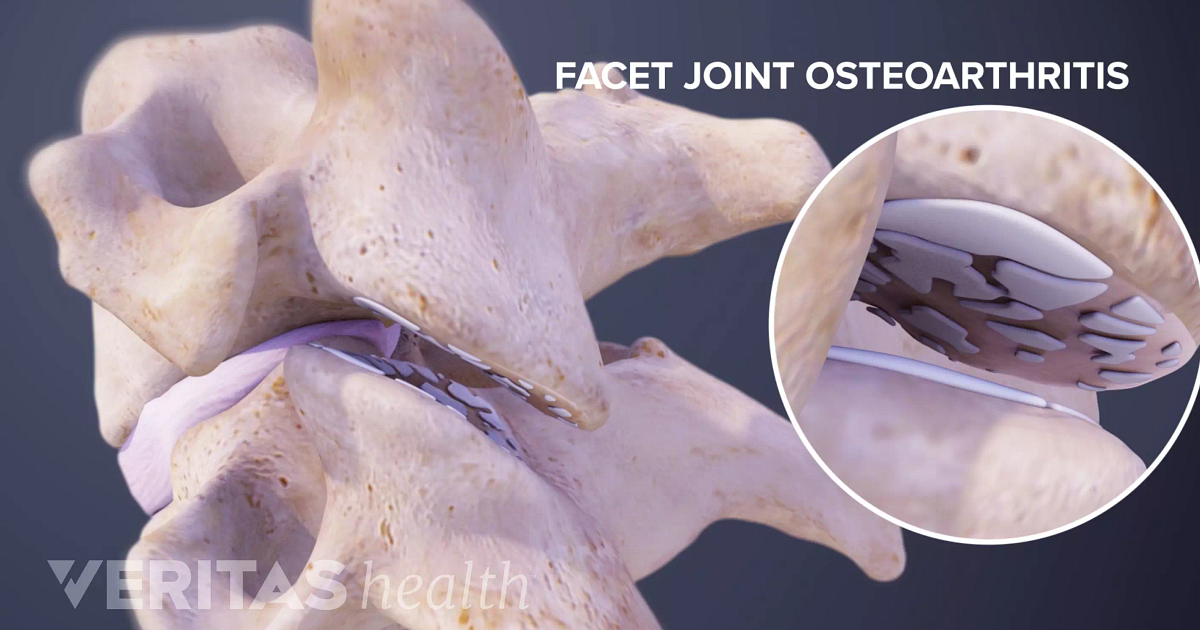 causes-of-lumbar-facet-joint-disorders