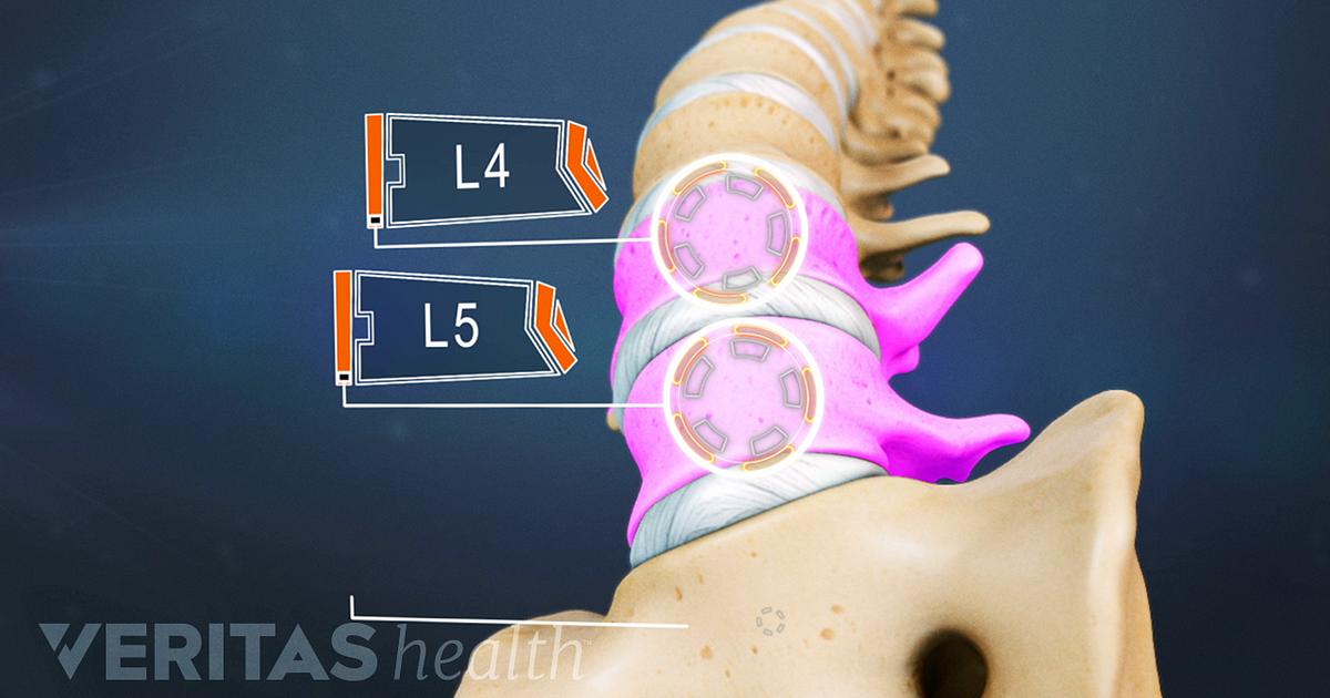 L4-L5 Treatment