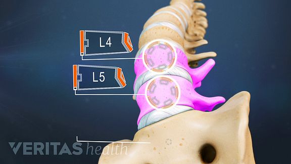 The two lowest segments of the lumbar spine, which includes L4-L5, carry the most weight and have the most movement, making the area prone to injury.