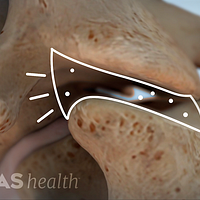 Highlighting the space between two vertebra where pressure can build and then pop.