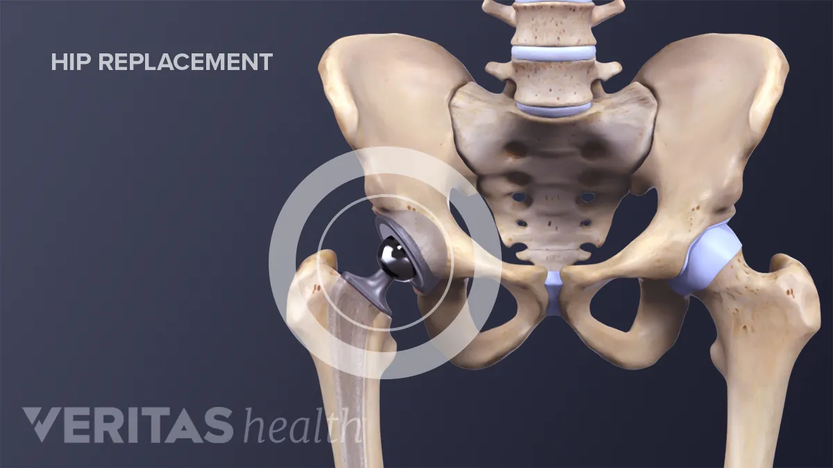 Total Hip Replacement Surgery in Omaha, NE