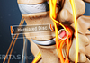 Lumbar herniated disc compressing a sciatic nerve root.