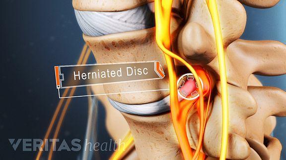Medical illustration of a lumbar herniated disc impinging on a nerve
