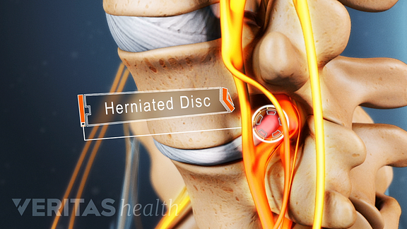 Lumbar Herniated Disc Symptoms, Treatments & Surgery