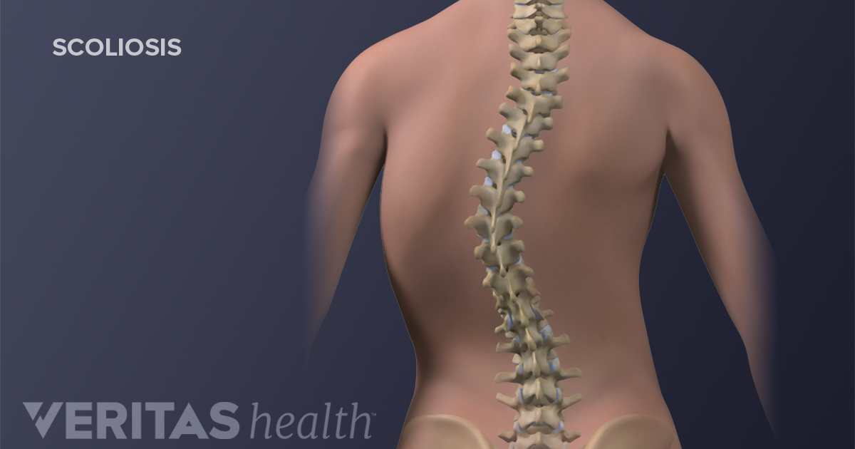Scoliosis Symptoms Treatment And Surgery