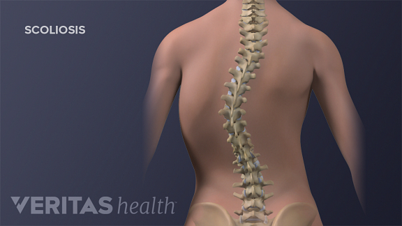 Adolescent thoracic scoliosis