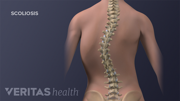 Illustration of adolescent thoracic scoliosis