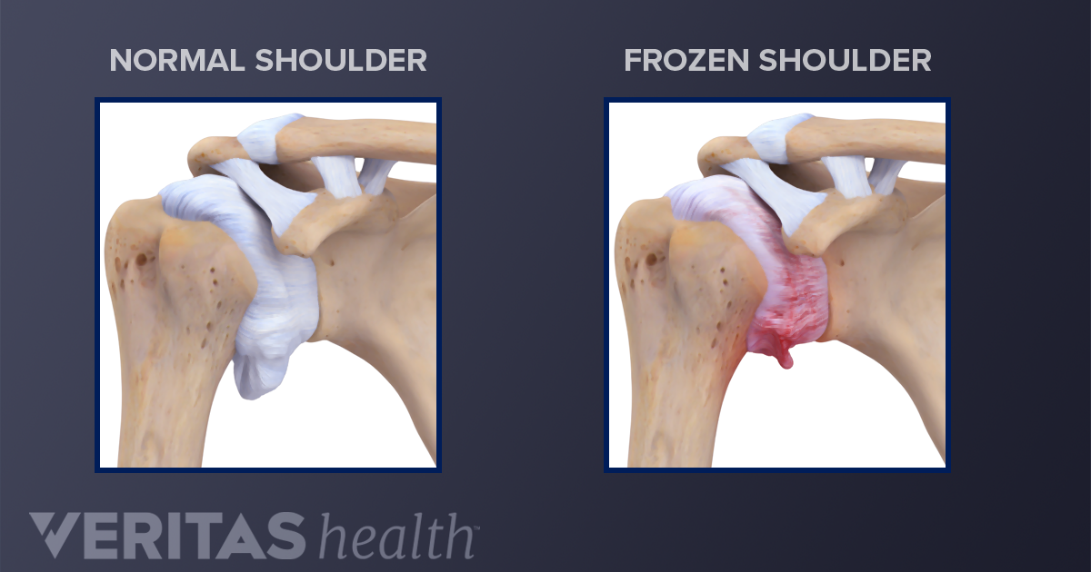 What To Know About Frozen Shoulder