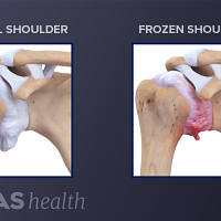 Cross section of normal joint compared to one with frozen shoulder (adhesive capsulitis).