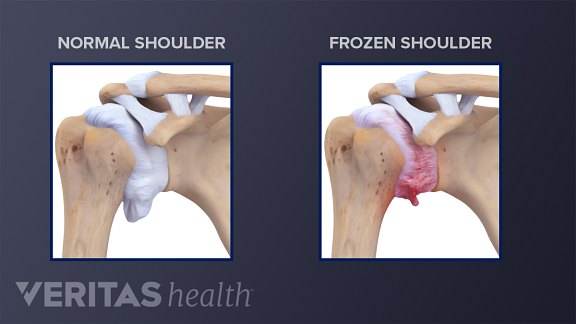 Comparing a normal shoulder joint and a frozen shoulder joint