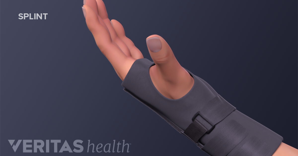 Nonsurgical Treatment for De Quervain's Tenosynovitis Nonsurgical Treatment for De Quervain's Tenosynovitis