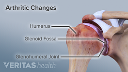 Illustration of arthritic changes in the glenohumeral joint.