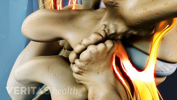 lumbar laminectomy