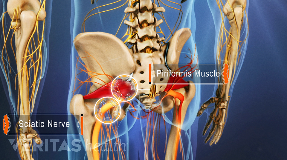 Slideshow: 5 Conditions that Commonly Cause Sciatica