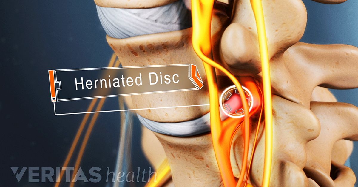 Insights and Advice About Herniated Discs