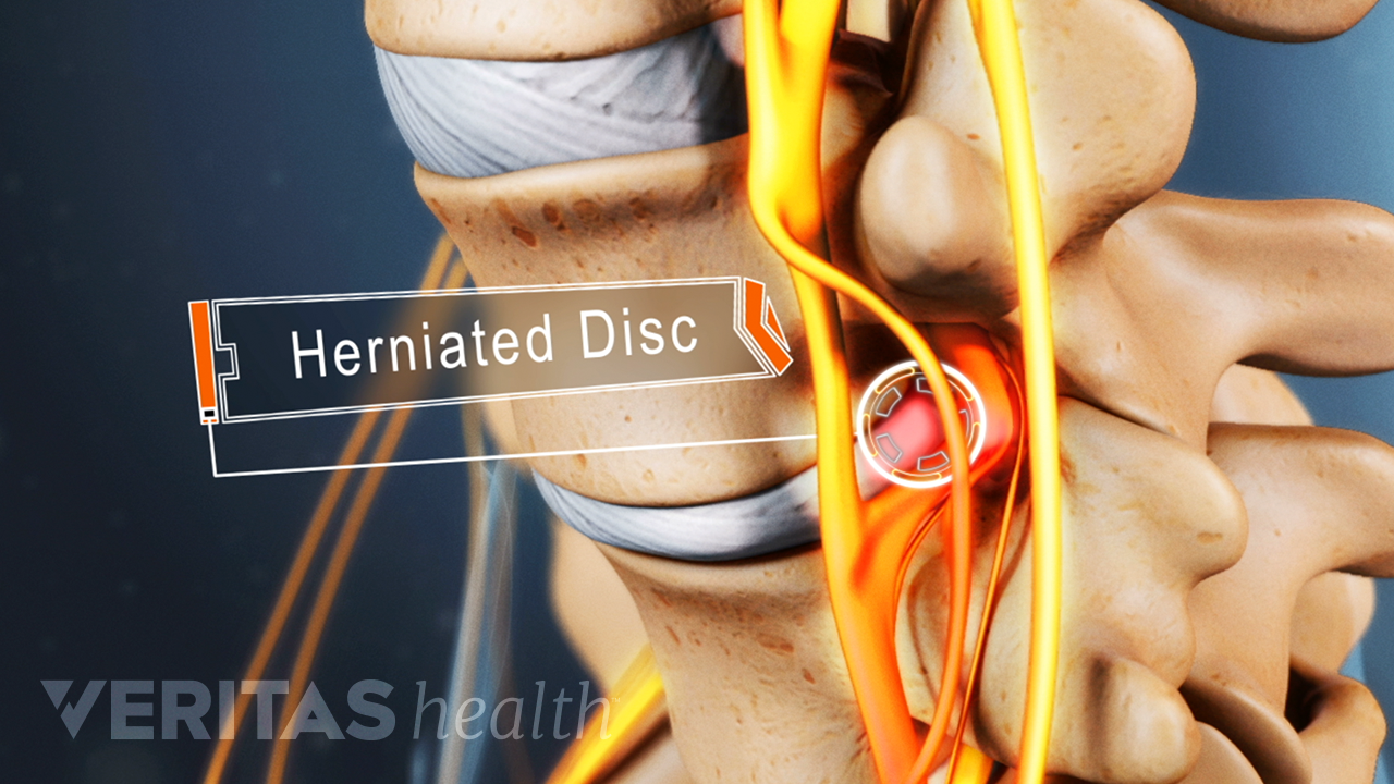 Profile view of a herniated disc in between two vertebrae in the lumbar spine
