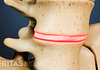 Spondylolisthesis in a disc of the lumbar spine.