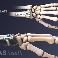 Internal fixation of a distal radius fracture