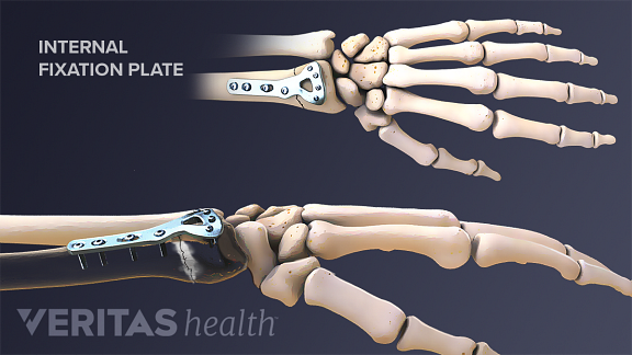 Illustration of an internal fixation of a distal radius fracture