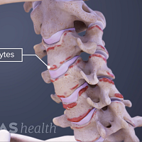 Profile view of the neck labeling osteophytes on the cervical spine.