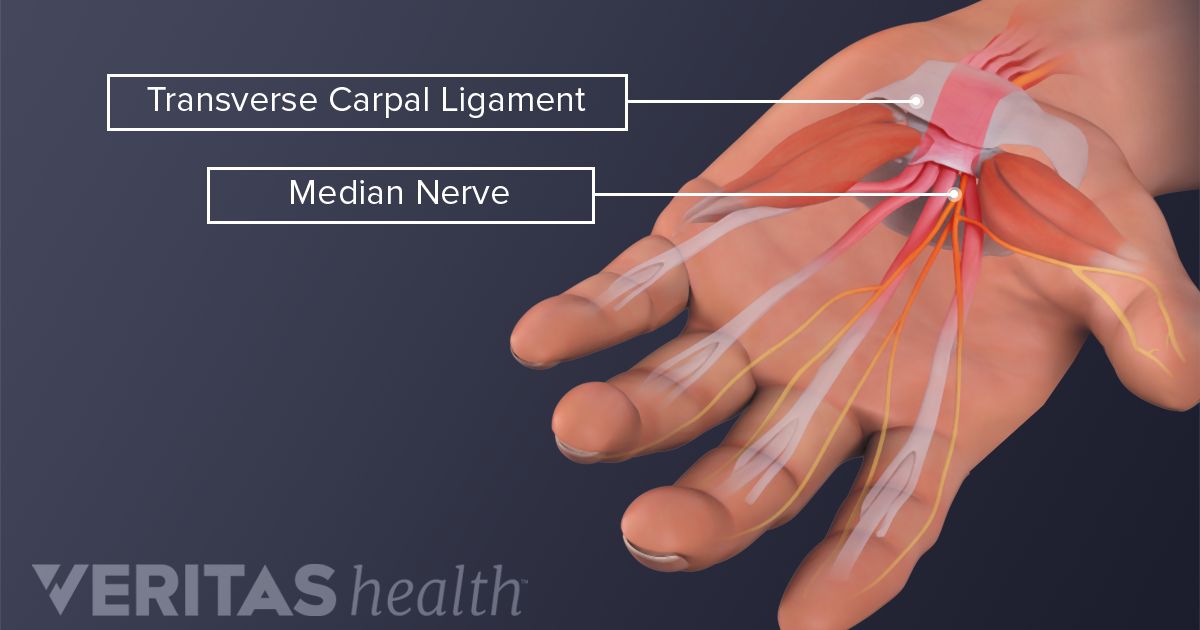 carpal tunnel syndrome carpal tunnel syndrome